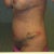 mild bruising, but . swollen. if you  can enlarge this, you can see the direction of the lift incision, hidden by tape now..