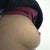 Side; 2 plus months post op