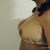 10 days post op