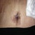 Belly button area 5 days post op