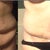 belly pic before and 4 weeks PO