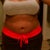 The morning of my surgery... my first "before" pic