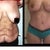 before and after tummy tuck
