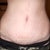 3 weeks post op