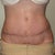 6 weeks after Full TT