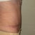 6 weeks after Full TT