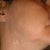 updated neck photo,  July 2012 Scar is no longer raised,  just have to cover with make up.  Same with the ear.