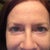 10/26/12  Can see uneveness of tear trough area.  Due to filler on Right lower lid.  Also still a little red.  Its like having 2 diff sides of face.  I'm not sure which one I like best.  The one with more space between lid and tear trough on Left (closer to the natural me) or the right side where more filler was added and not as much space at all between lid and tear trough line.  Anyway, if they could just match it would look better.