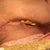thats gauze in the incision-I have change 3xs daily and soak the gauze w/ betadine! Oh so sexy