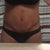 Day 20 - scabs are visible but the swelling is slowly going down.  Began scar treatment yesterday.