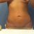 No more stitches! Yay! Still feel bloated.