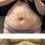 Tummy before and then at 10 days. Belly button stitches still there, drains out, some fluid buildup. I added dotted lines to show where he cut (approx). Sorry, too modest to show the breasts!