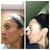 one week later, before and after, left side of face