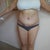 10 days post-op.