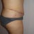 10 days post-op.