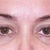 Exactly one month later the same circles are visible again and the blueness has not disappeared under one eye.