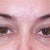 Exactly one month later the same circles are visible again and the blueness has not disappeared under one eye