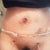 4 days PO...Scar is low, some bruising, little swelling.