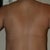 Mommy Makeover pre-op. Rear view! Ahhhhhh!