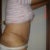 8 days post surgery right side