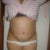 8 days post surgery front