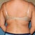 Here is an after with my bra on. I can still see some roll but not half as bad as what it was before the procedure.