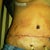 my pubic area was pulled up so high it is now 2 inches above my pant line the tattoo used to be where the drains are
