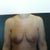 After augmentation. Much better!!