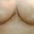 11 days post-op! i had a piece of surgical tape on my left boob