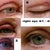 right eye progression thru 14 days post op.
