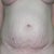 2 Days Pre-op