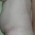 2 Days Pre-op