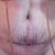 3 Days Post-op