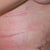 3 Days Post-op