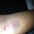 Crazy bruise on my arm from having a rolling vein when they tried to put the IV in my arm, ended up having to go in my hand.