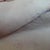 Left sutures, 15 days post-op.