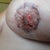 Looking better for those of you who were worrying ;) -- 15 days post-op.