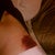 hey look--a person is in those bruises! Day 2 bruises from lipo--or where people kicked me while I was knocked out.
