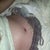 1 week post op
