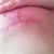 right side incision underneath breast