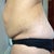 Here is a side view before surgrey!