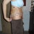 Side view one week post op