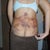 Back view one week post op