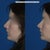 Before/after - computer imaging from a consultation.