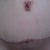 revision 3 month postop