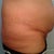 my BUTT is the left side.. gross! 1 day pre op