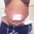 10 days post op.