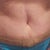 Look at the strange old scar that appeared under my belly button.  Do you think it's left-over from my hernia or a stretch mark that I don't recognize?