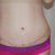 3 weeks incision. that's not swelling at my incision. since my TT as not extended to my sides, i do have some laxity on the sides and back as well, so i still get a side muffin top. take my advice - if you are loose all the way around, get the extended.