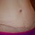 3 weeks. close up of scar. you can see how the incision is higher on the left - that is where my seroma is. also, notice the red dot right above the incision in the middle? i have a few of those. that is where a little knot of suture is outside of my skin. not exactly sure what to do with those places. will ask my PS next week.